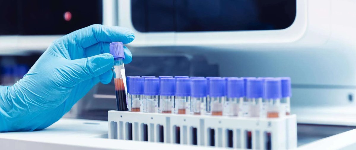 Clinician's hand loading a test tube with a purple cap into a test tube rack to be placed in an IVD machine in a lab.